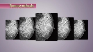 乳房斷層攝影