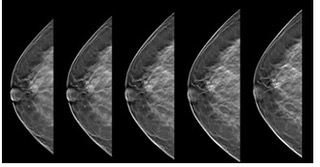 乳房斷層攝影